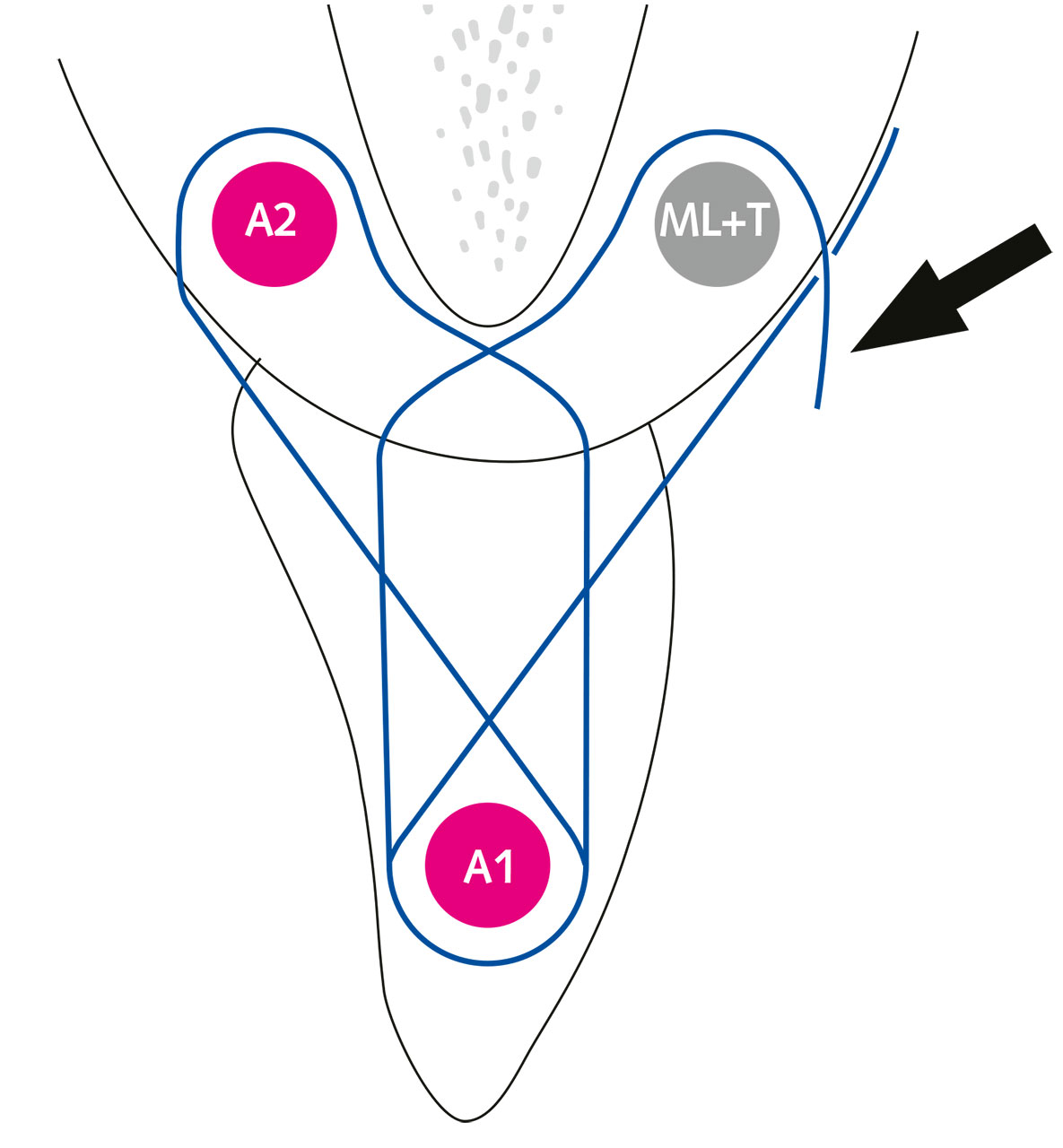 Abb. 20 Schematische Darstellung der Lappen- und Transplantatstabilisierung (Pfeil) durch eine vertikale „double crossed suture“. Das interdental angebrachte Composite sowie die mastikatorische Gaumenmukosa  dienen als Anker (ML + T = mobiler Lappen und Transplantat, A1 = Anker 1, A2 = Anker 2).
