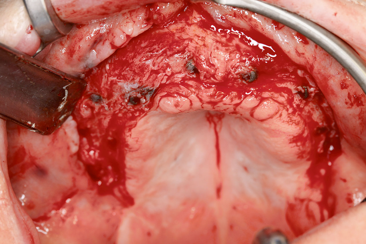 Abb. 17 Klinische Falldarstellung: Implantatfreilegung mittels Mukosalappen unter Intaktlassung des Periosts und somit ohne Denudierung des augmentierten Knochens.