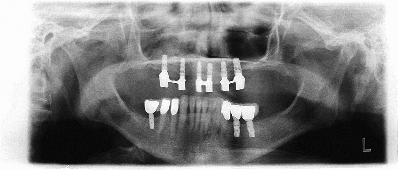 Abb. 20 ... radiologische Aufnahme drei Jahre nach prothetischer Versorgung der im Onlaygraft verankerten Implantate.