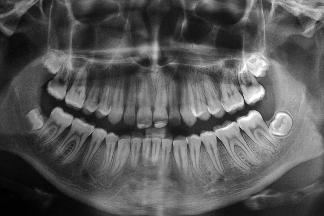 Abb. 2 Panoramaschichtaufnahme mit Anlage der Zähne 18, 28, 38 und 48, Opazitäten inzisal bei den Zähnen 11 und 21 im Sinne von Kunststofffüllungen sowie altersentsprechendem Verlauf des krestalen Knochenniveaus.