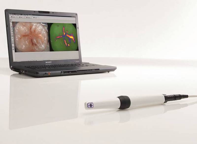 2011: Einführung der Multifunktionskamera VistaCam iX zur Diagnose und Früherkennung von Karies sowie Plaque-Visualisierung. (Foto: Dürr Dental)
