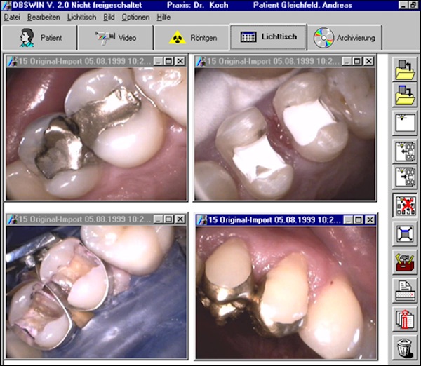 1995: Das dentale Video-System VistaCam erweitert die diagnostischen Möglichkeiten und verändert die Zahnarzt-Patienten-Kommunikation. Der Bildschirm erreicht die Behandlungseinheit, Imaging am PC unterstützt die Diagnostik. (Foto: Dürr Dental)