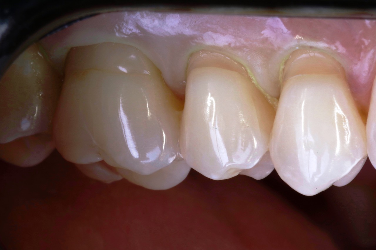 Kariesfreie, schmerzempfindliche, zervikale Läsionen mit eingesetztem Retraktionsfaden  an den Zähnen 14 bis 16.