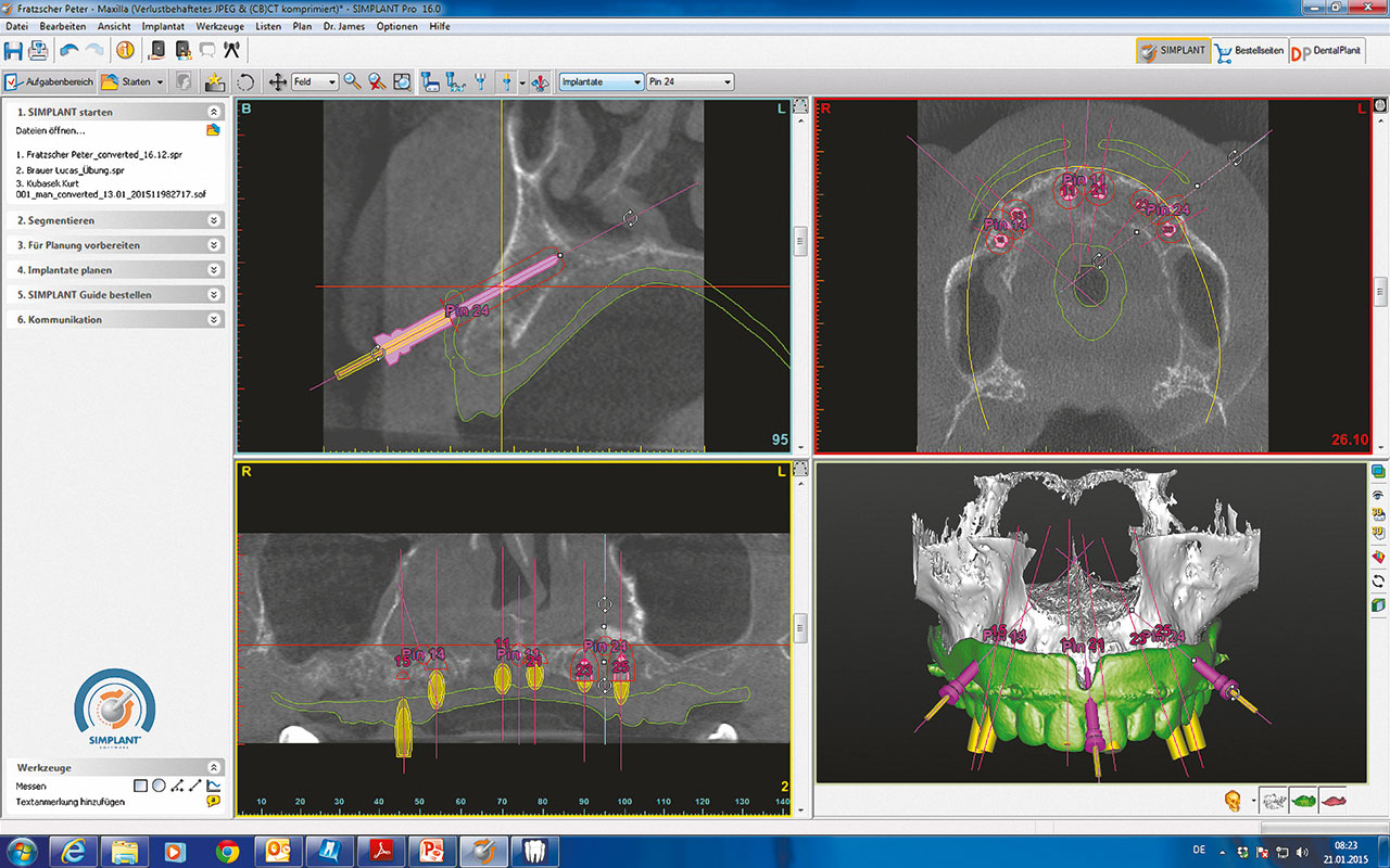 Abb. 5 Virtuelle Planung der Implantate und Fixationspins (SIMPLANT, Dentsply Implants, Mannheim) ...