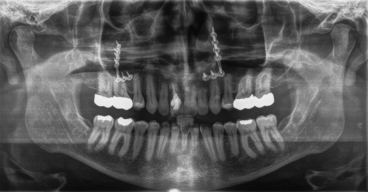 Abb. 13 ... und röntgenologischer Befund von Zahn 11 mit Elongation und Resorption des Zahns.