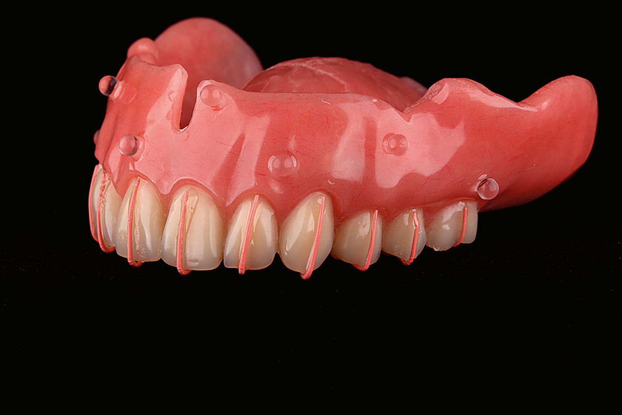 Abb. 6 Oberkiefertotalprothese mit röntgenfähigen Glasperlen und die Zahnachse darstellenden Guttaperchastreifen, die anstelle einer Röntgenschablone für eine DVT-Aufnahme verwendet wird.