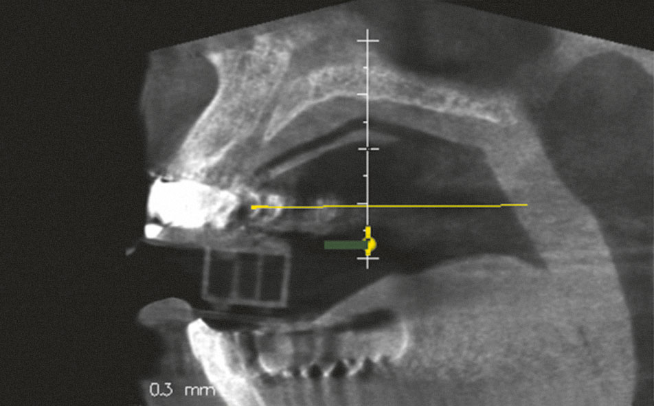 Abb. 9 Insuffiziente Passung einer Röntgenschablone im Oberkiefer: ein sichtbarer Spalt zwischen Röntgenschablone und Mukosa in sagittalem ...
