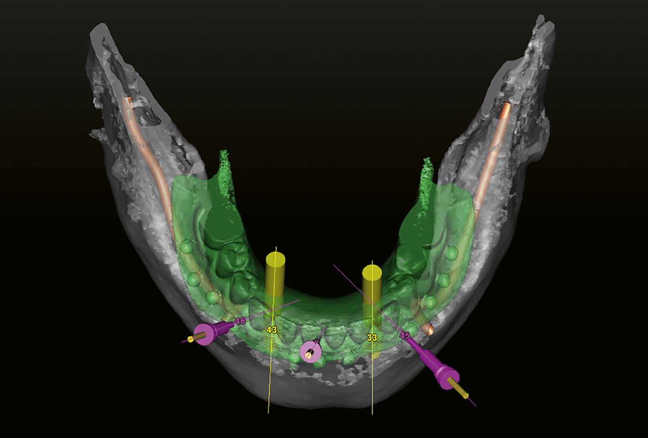 Abb. 17 Die geplanten Positionen der Verankerungsstifte (rosa) in einem Unterkiefer mit der Scanprothese und zwei geplante Implantate in der Interforaminalregion (gelb).