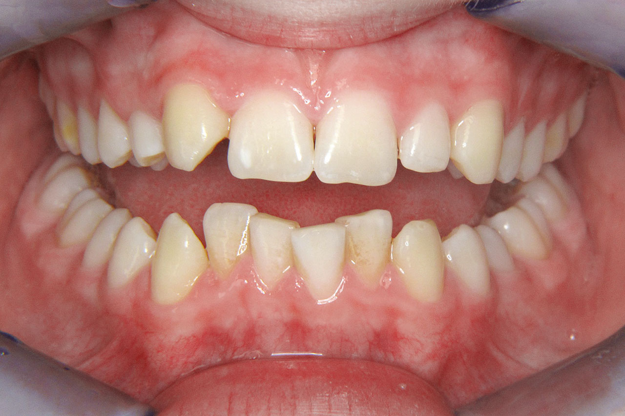 Abb. 1 Nichtanlage Zahn 12 und mesial durchgebrochener Zahn 13.