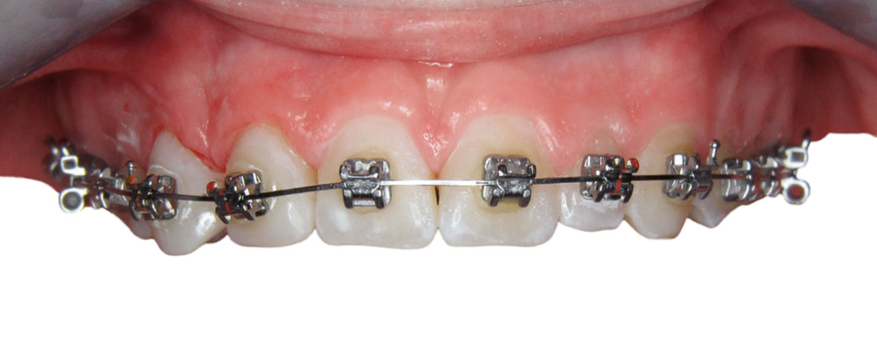 Abb. 13 Re-Bonding der Brackets auf den Verblendschalen und weitere Detaillierung der Zahnstellung.
