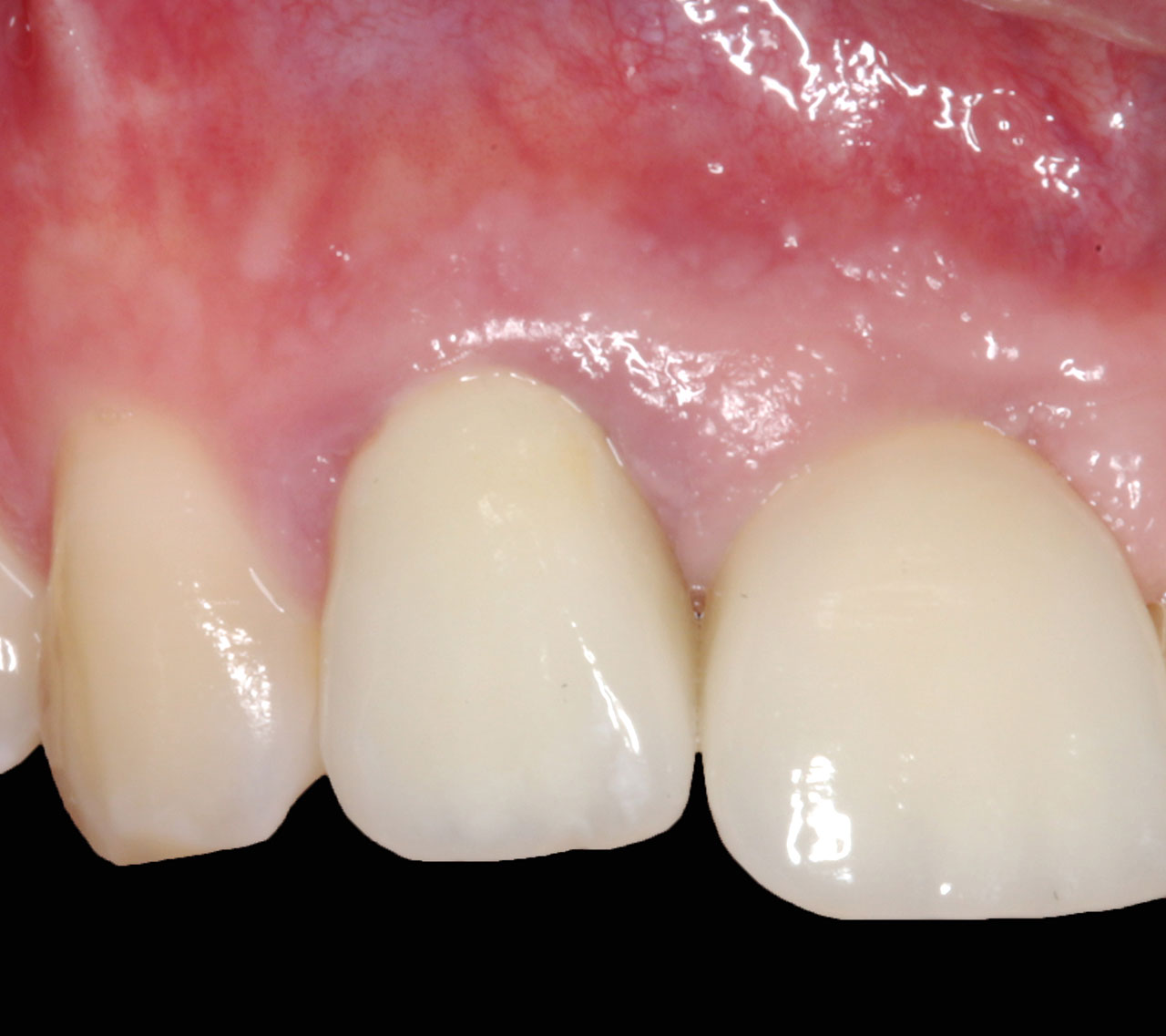 Abb. 2 Frontalansicht Zahn 12 präoperativ