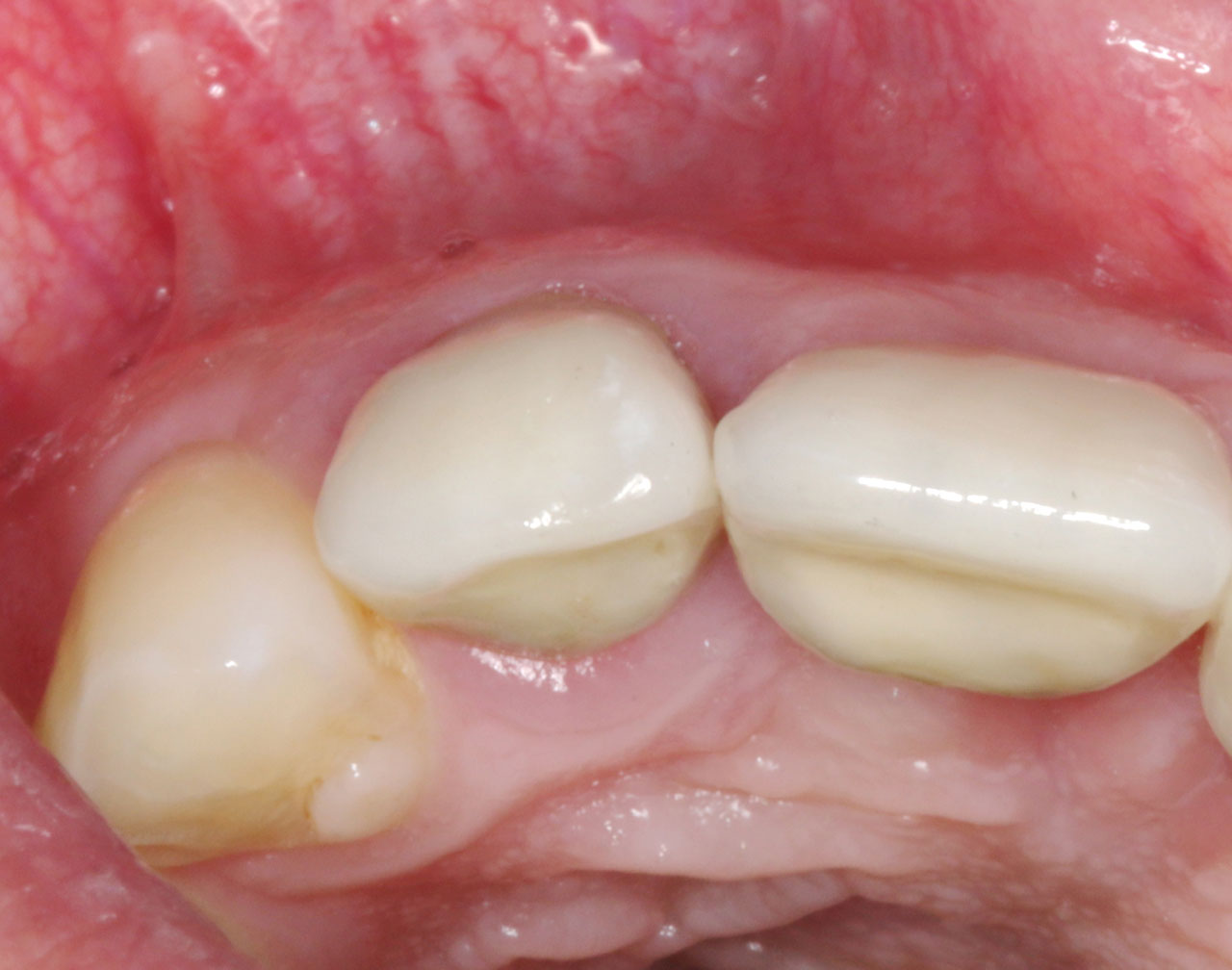 Abb. 3 Okklusalansicht Zahn 12 präoperativ. (Beachte die bukkale Zahnfleischkontur)