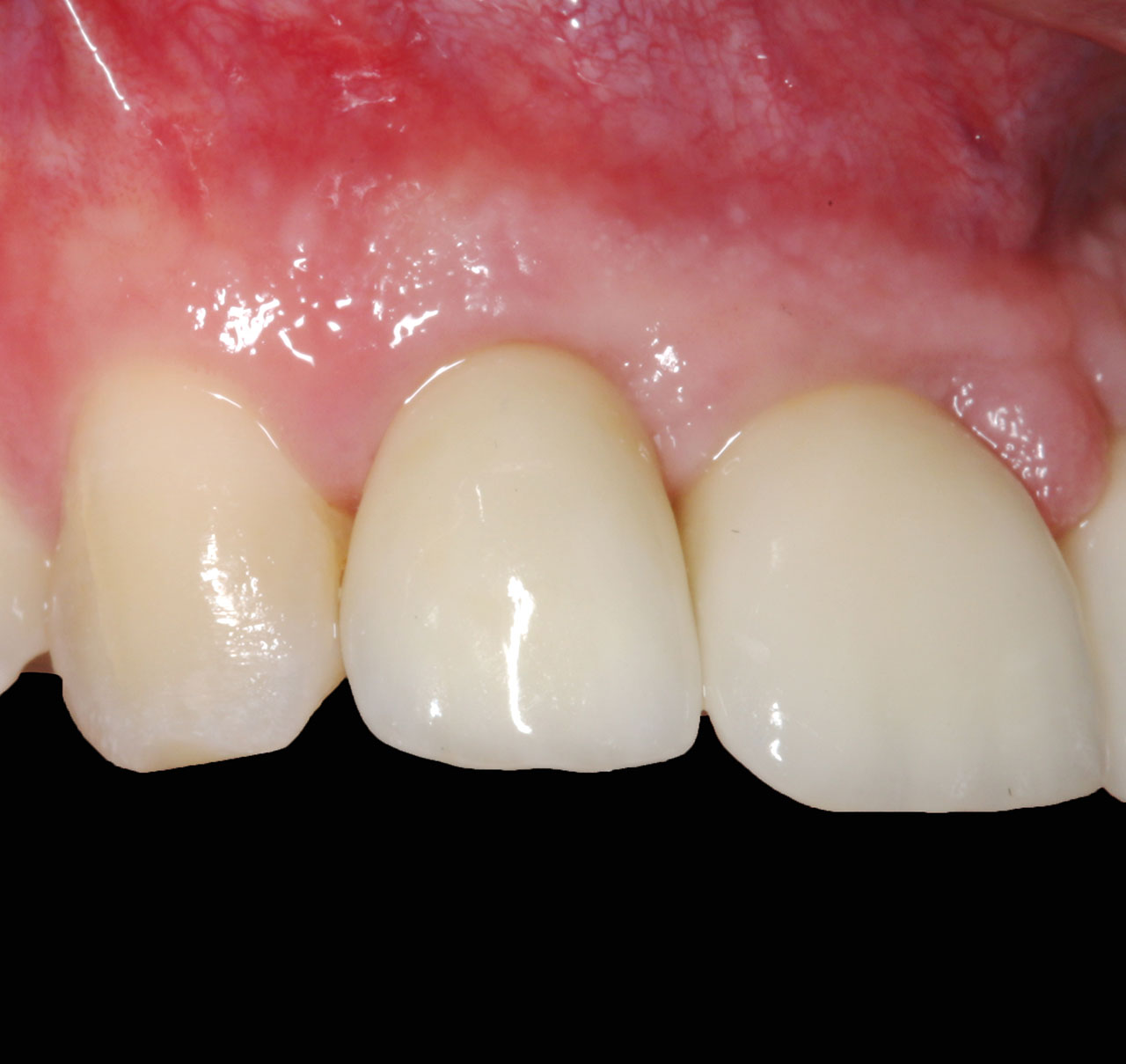 Abb. 16 Frontalansicht der fertigen Versorgung mit natürlichen Zahnfleischverhältnissen.