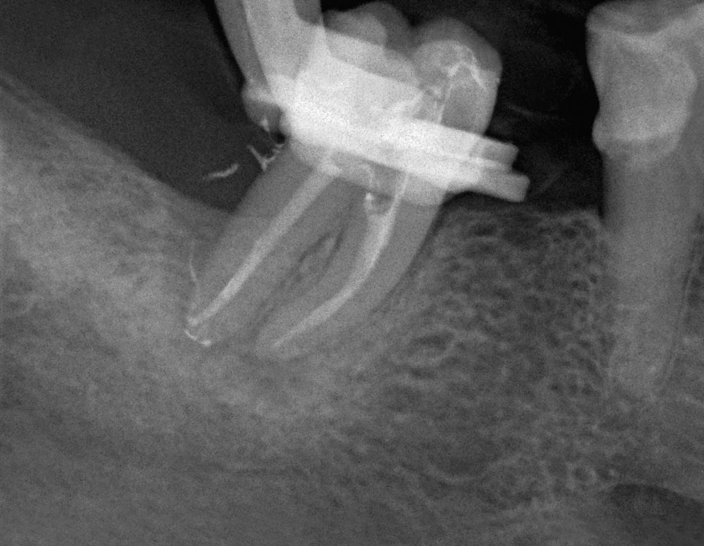 Abb. 1 73-jährige Patientin mit 12-jähriger oraler Bisphosphonateinnahme (Alendronat) aufgrund einer Osteo­porose mit einer ausgedehnten Endo-Paro-Läsion an Zahn 47.