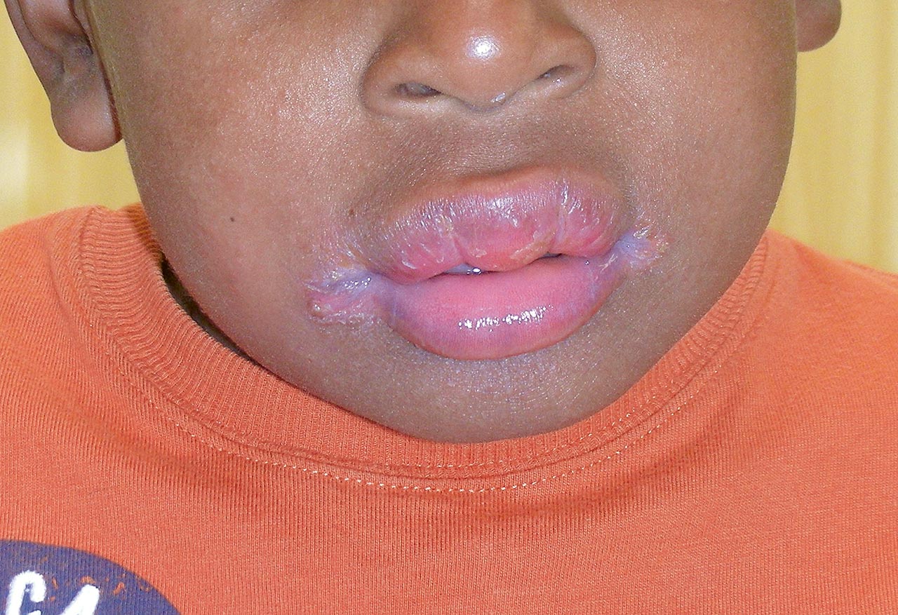Abb. 1 und 2 9-jähriger Patient mit rezidivierenden Lippenschwellungen
