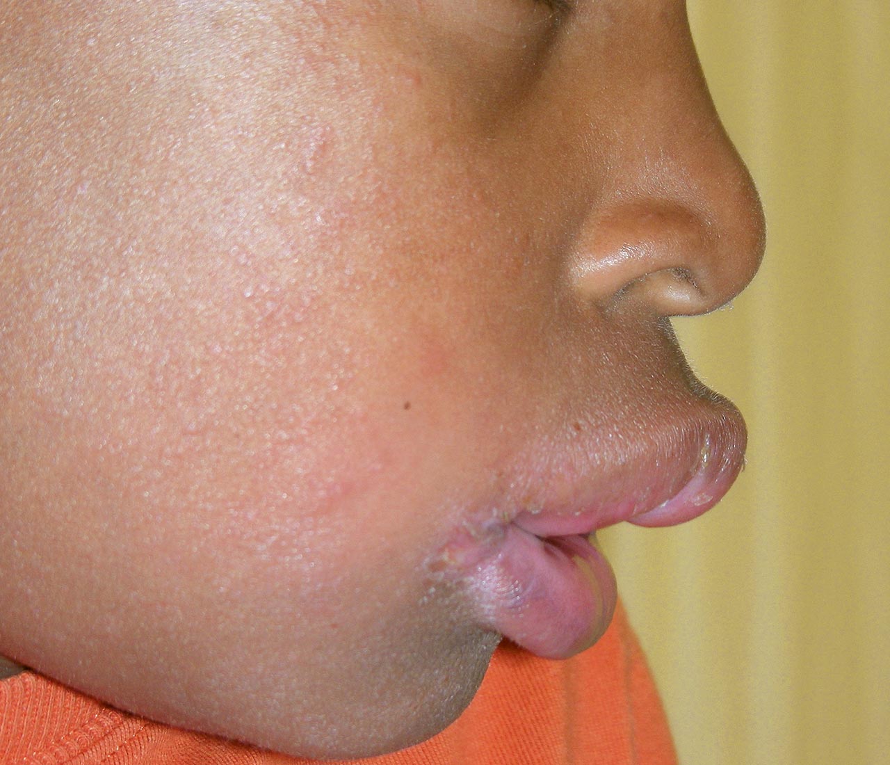 Abb. 1 und 2 9-jähriger Patient mit rezidivierenden Lippenschwellungen