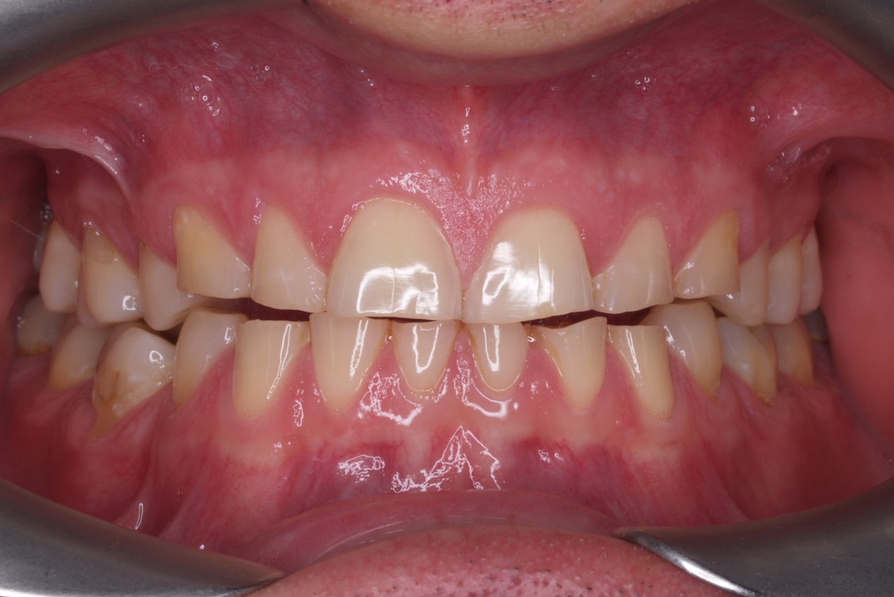 Abb. 1 Substanzverlust durch Knirschen oder Pressen der Zähne aufgrund einer sich wiederholenden Kaumuskelaktivität. Bild: Ahlers