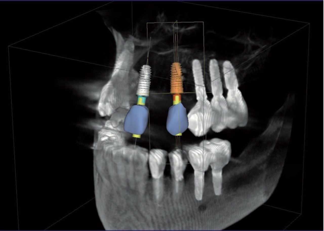Abb. 5 Integration der CAD/CAM-Daten in den DVT-Datensatz zur restaurationsgerechten digitalen Implantatplanung. Bild: Holtorf