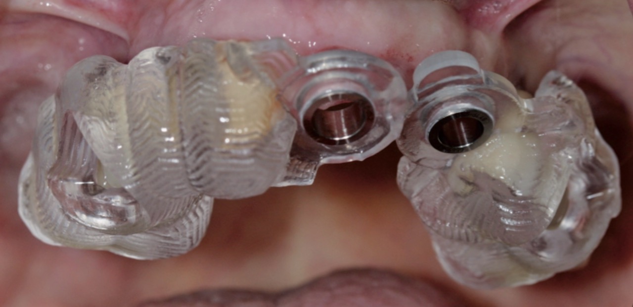 Abb. 6 Chirurgische Bohrschablone zur Platzierung von Implantatpfeilern, gefertigt auf Basis von DICOM-Daten aus dem DVT. Bild: Holtorf
