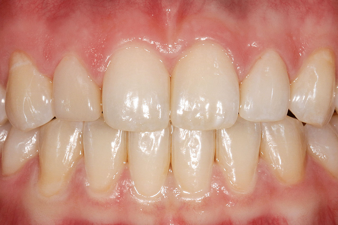 Abb. 7 Zustand nach direkter Verbreiterung der Zähne 11 bis 23