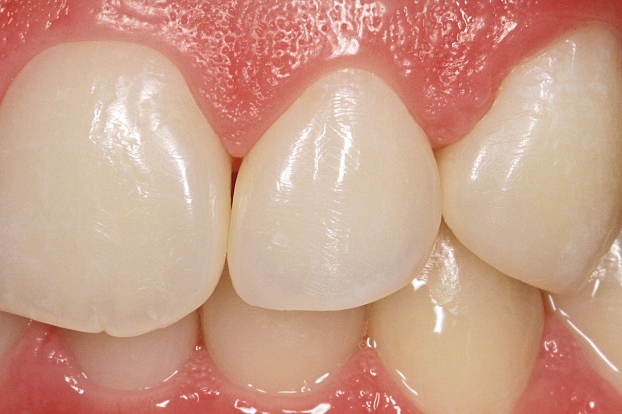 Abb. 9 Nach dem Aufbau mit Komposit fügt sich der Zahn harmonisch in die Zahnreihe ein.