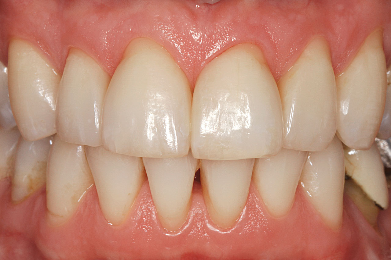 Abb. 11 Zustand nach Entbänderung und anschließender Reduktion der schwarzen Dreiecke von Zahn 12 bis Zahn 22 mit gleichzeitigem Ersatz der Klasse-III-Füllungen an den Zähnen 11 und 21 jeweils mesial.