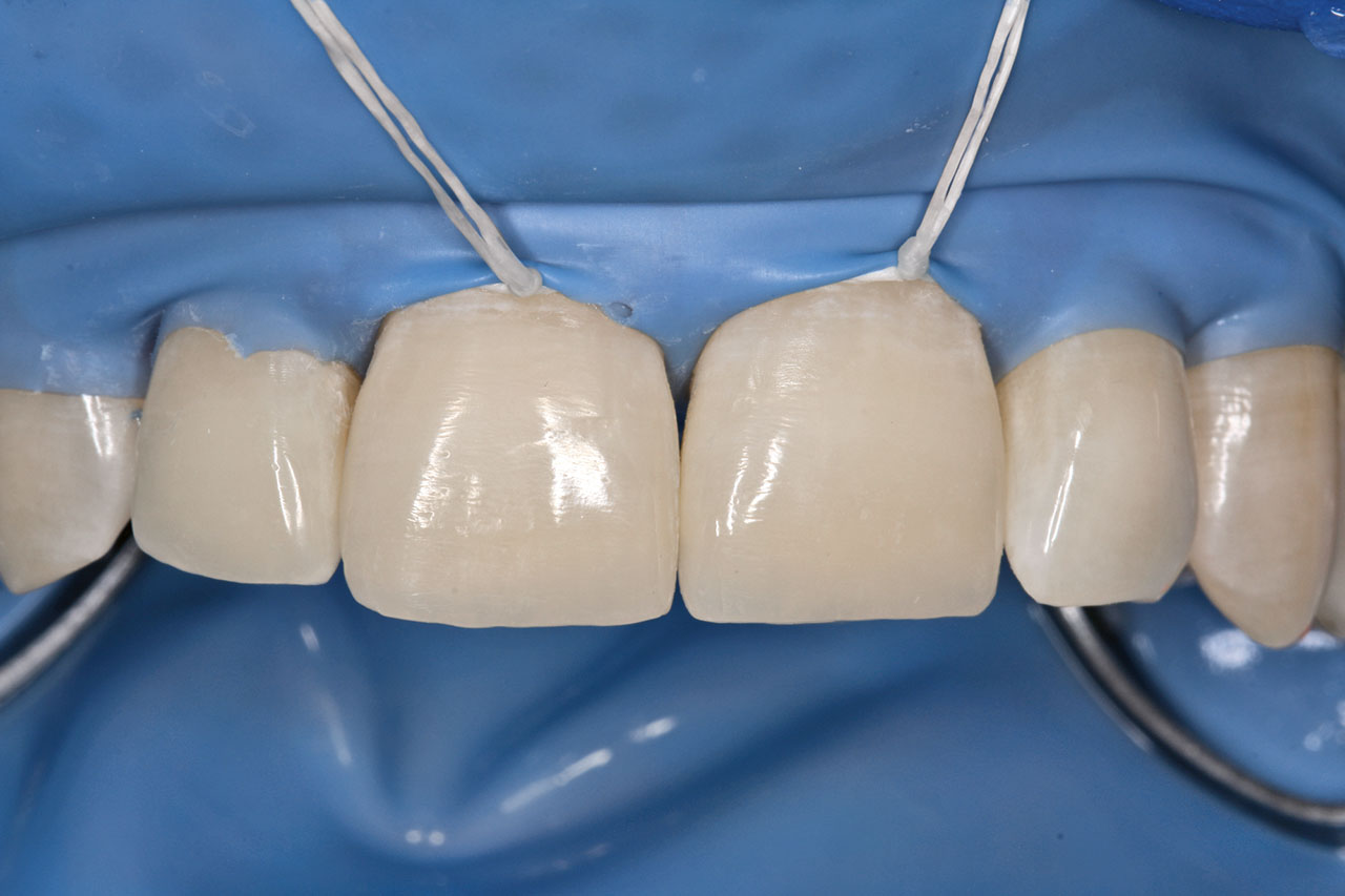 Abb. 14 Zustand nach Kompositaufbau mit Verlängerung der Inzisalkanten an den Zähnen 12, 11 und 21.