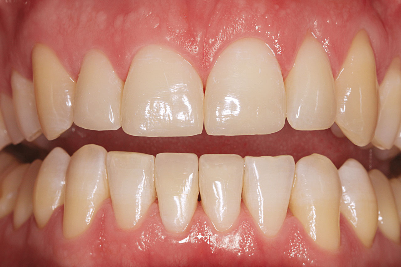 Abb. 15 Zustand nach Fertigstellung der Behandlung mit Restaurationen an den Zähnen 12, 11, 21, 31 und 41.
