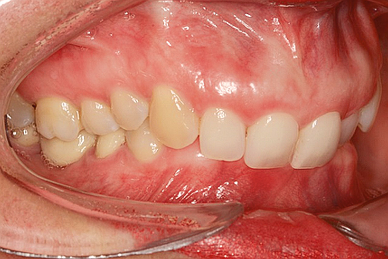 Abb. 2 Anfangsbefund: intraoraler Fotostatus eines erwachsenen Patienten mit parodontal geschädigtem Gebiss, Angle-Klasse II,2 und Tiefbiss (Deckbiss).