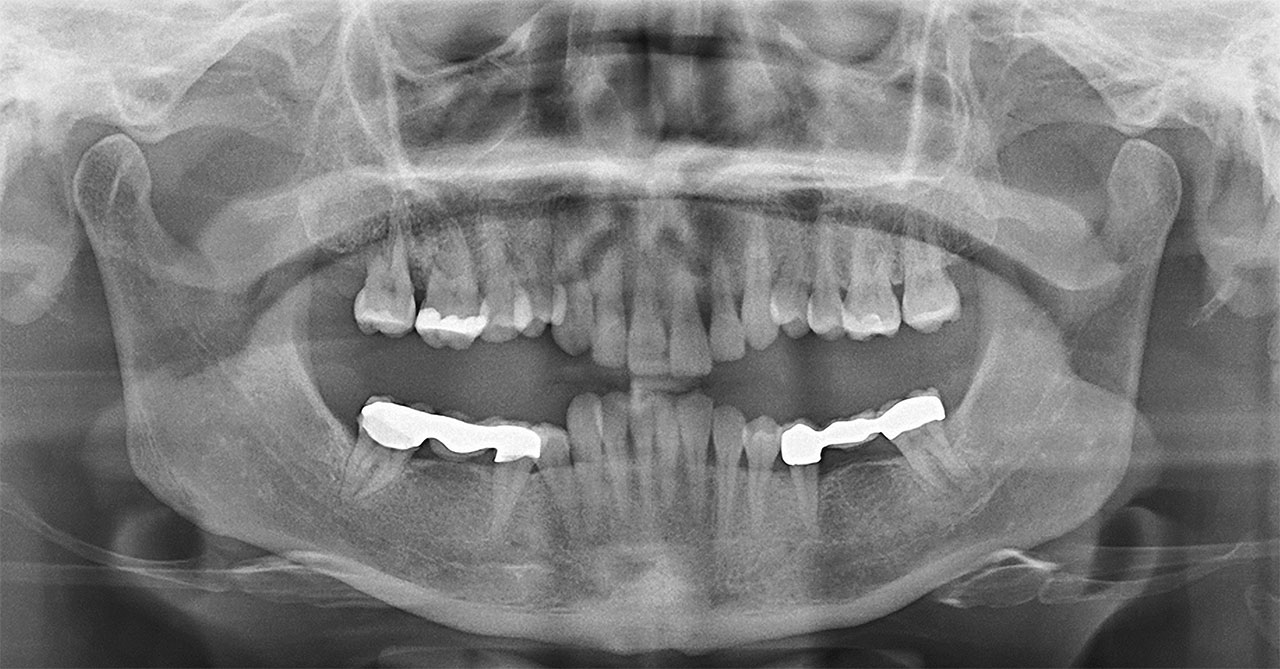 Abb. 7 Anfangsbefund: Panoramaschichtaufnahme. Nicht erhaltungswürdiger Zahn 17 mit ausgeprägtem parodontalem Knochenverlust. Generalisierter horizontaler Knochenverlust im Frontzahnbereich. Festsitzende Brückenversorgung im Unterkieferseitenzahnbereich beidseits.