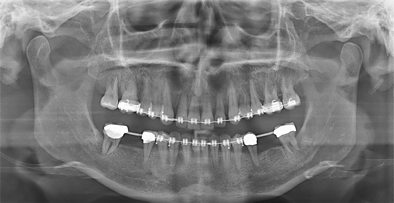 Abb. 8 Zwischenbefund: Panoramaschichtaufnahme. Zustand während prächirurgischer orthodontischer Ausformung der Zahnbögen nach kombinierter Intrusion und Protrusion der Frontzähne im Ober- und Unterkiefer sowie Aufrichtung der unteren zweiten Molaren nach Entfernung der Brückenzwischenglieder 36 und 46.