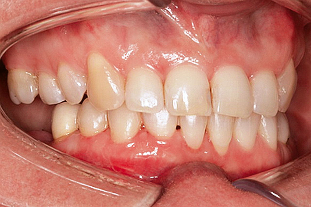 Abb. 10 Endbefund: intraoraler Fotostatus. Zustand nach Entfernung der Multibracketapparatur, Extraktion der  Zähne 17 und 47 sowie Implantation in Regio 46 und 36.