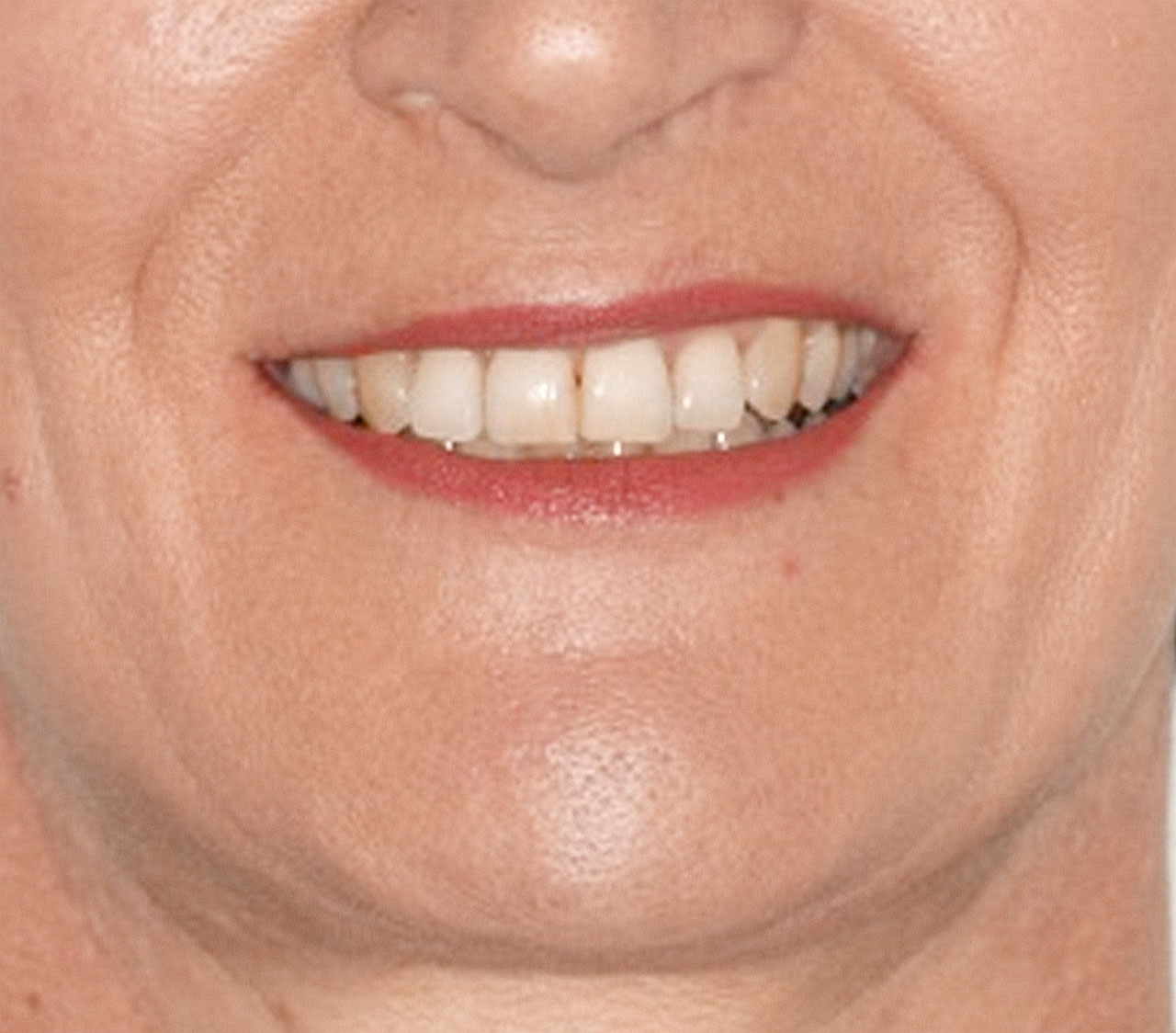 Abb. 20 ... und Endbefund. Vor allem durch die kombinierte Intrusion und Protrusion der oberen Frontzähne mit Beseitigung des „gummy smile“ konnte eine deutliche Verbesserung des ästhetischen Erscheinungsbildes erreicht werden.