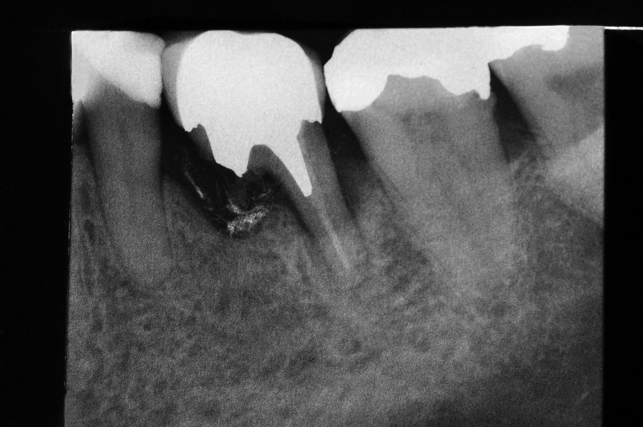 Abb. 5 Kleinbildröntgenaufnahme Zahn 36