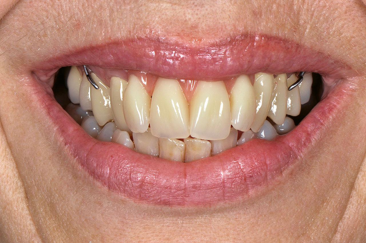 Abb. 8 Lippenbild mit provisorischem Zahnersatz zur Beurteilung der Zahnaufstellung.