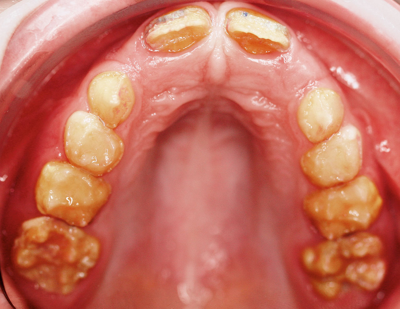 Abb. 8  Amelogenesis imperfecta (schwere Form) – die genetisch bedingte Strukturstörung tritt familiär gehäuft auf (Familienanamnese) und betrifft alle Zähne. (Foto: Schmoeckel)