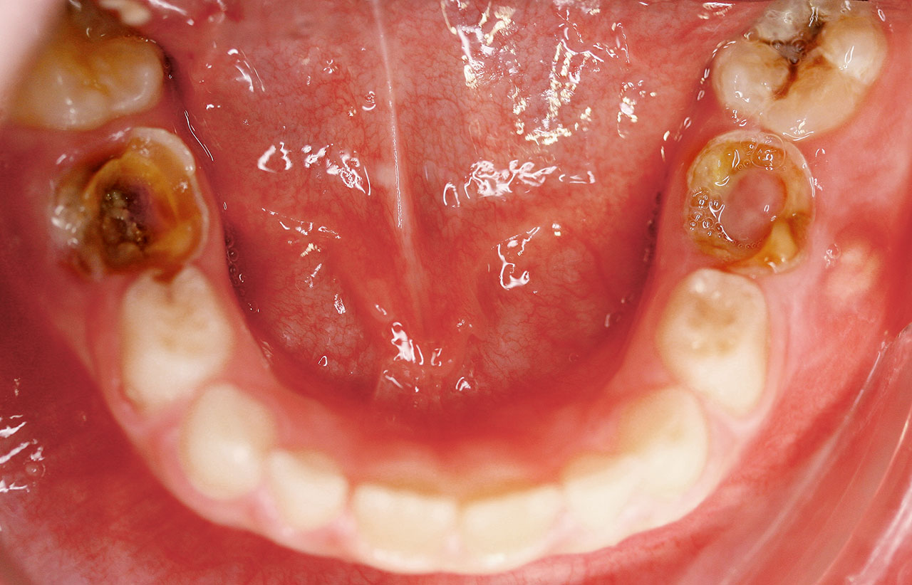 Abb. 9  Karies an 36 lässt sich von MIH gut unterscheiden, da es in der Fissur auftritt, zudem gibt auch der Zustand des restlichen Gebisses Aufschluss über einen suboptimalen Zahnstatus durch Karies. In regio 75 ist unterhalb des Wurzelrestes auch vestibulär eine eitrige Entzündung zu sehen, die einen sogenannten Turner-Zahn verursachen kann (vgl. Abb. 12). (Foto: Schmoeckel)