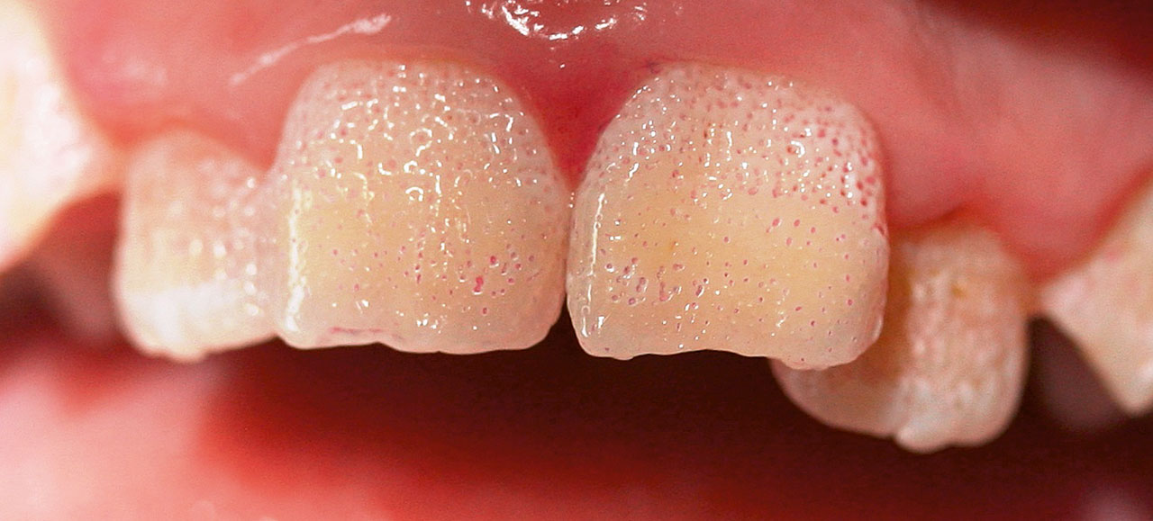 Abb. 10  Leichte Form der Amelogenesis imperfecta mit Grübchenbildung bei normaler Dicke des Zahnschmelz, die aufgrund des Erscheinungsbildes klar von MIH zu unterscheiden ist. (Foto: Schmoeckel)