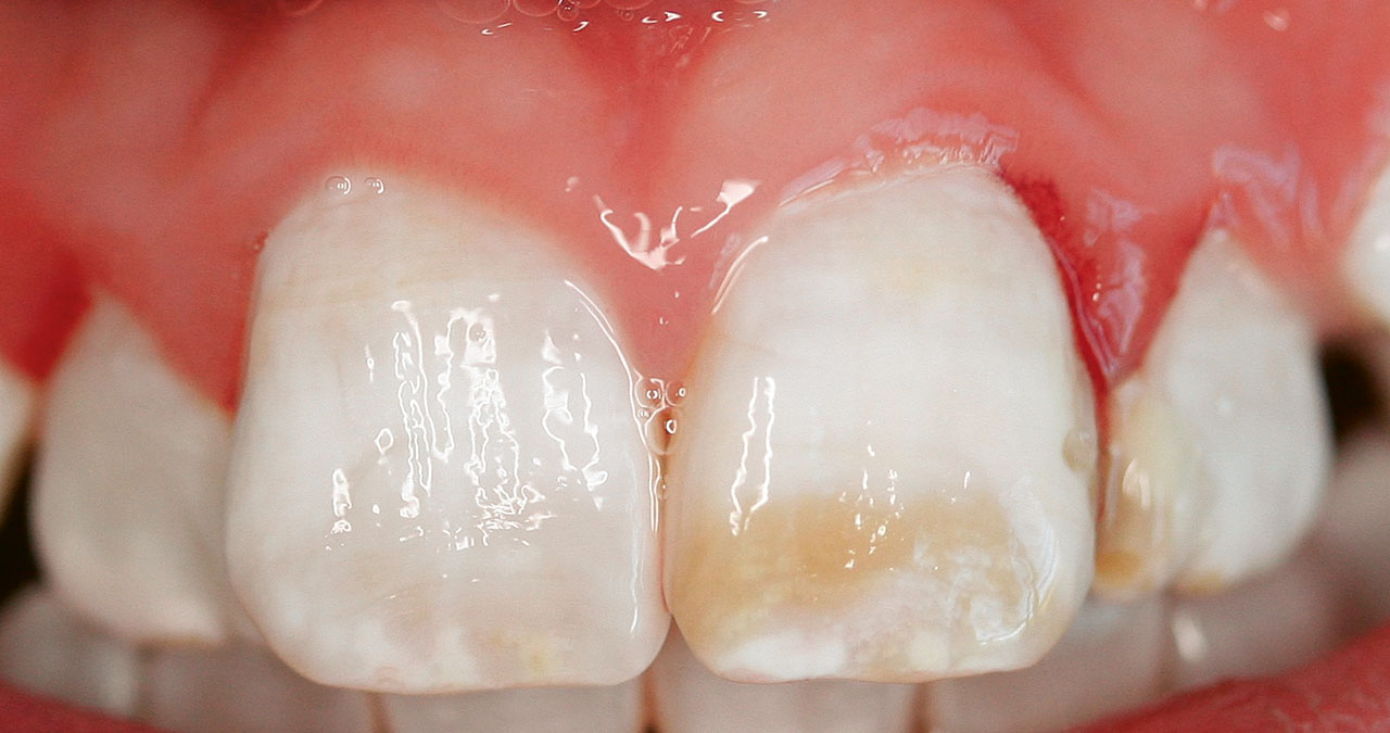 Abb. 13  Dentalfluorose an den OK Schneidezähnen nach Einnahme von Fluoridtabletten im ersten Lebensjahr. (Foto: Schmoeckel)