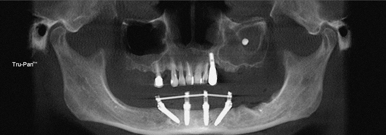 Abb. 1 DVT-Bildgebung: verschatteter linker Sinus maxillaris mit zentralem, metalldichtem Fremdkörper.