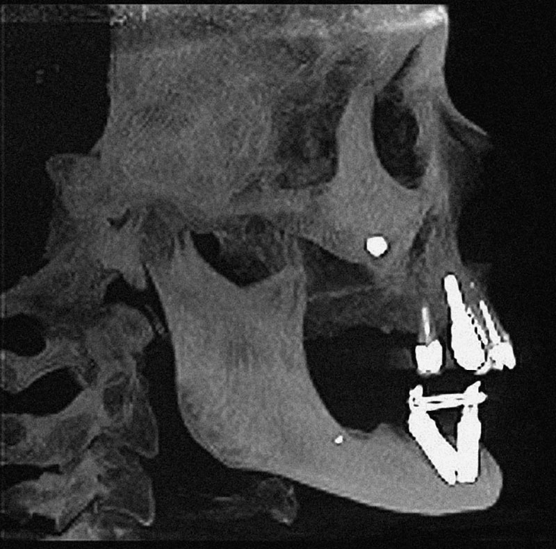 Abb. 2 Sagittale DVT-Darstellung der verschatteten Kieferhöhle links.