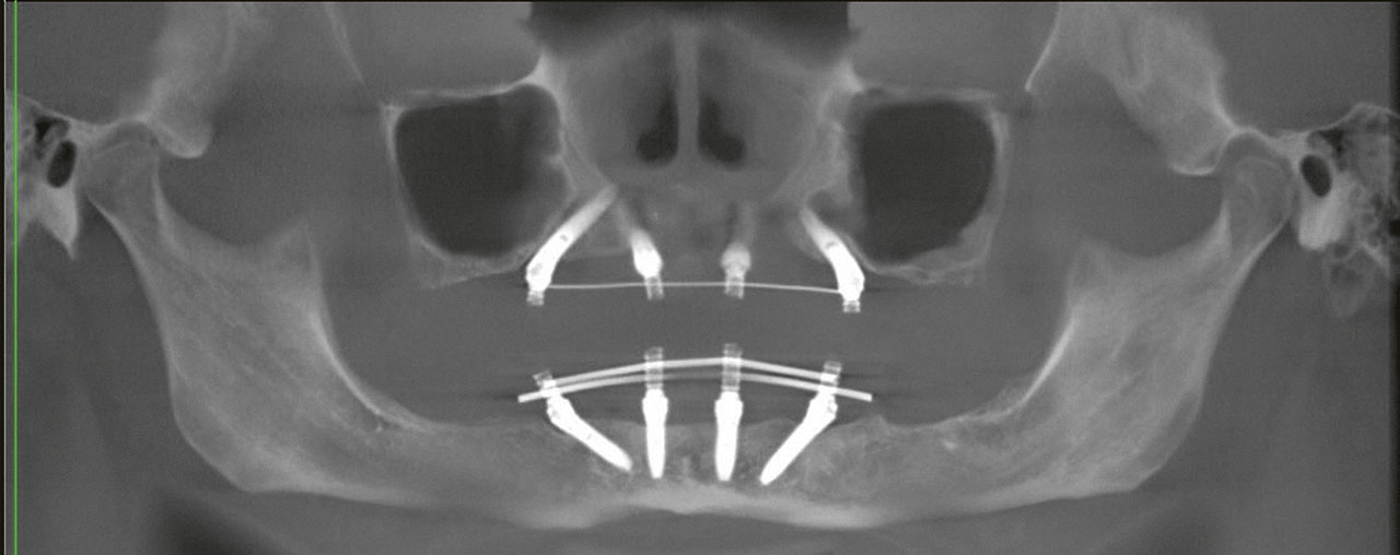 Abb. 15 DVT-Bildgebung mit Sinus maxillaris bei der Nachkontrolle nach 1 Jahr.