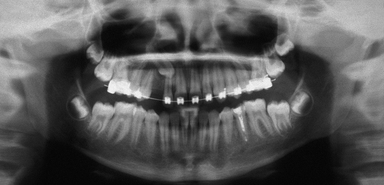 Abb. 2 Zur radiologischen Abklärung der Lagebeziehung von Zahn 13 wurden eine PSA ...