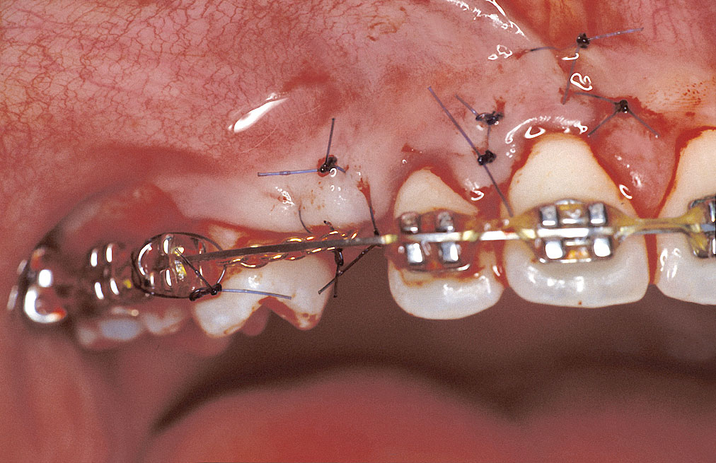Abb. 6 Die Wunde wurde primär dicht verschlossen und die Goldkette am Bracket des Zahns 14 befestigt.