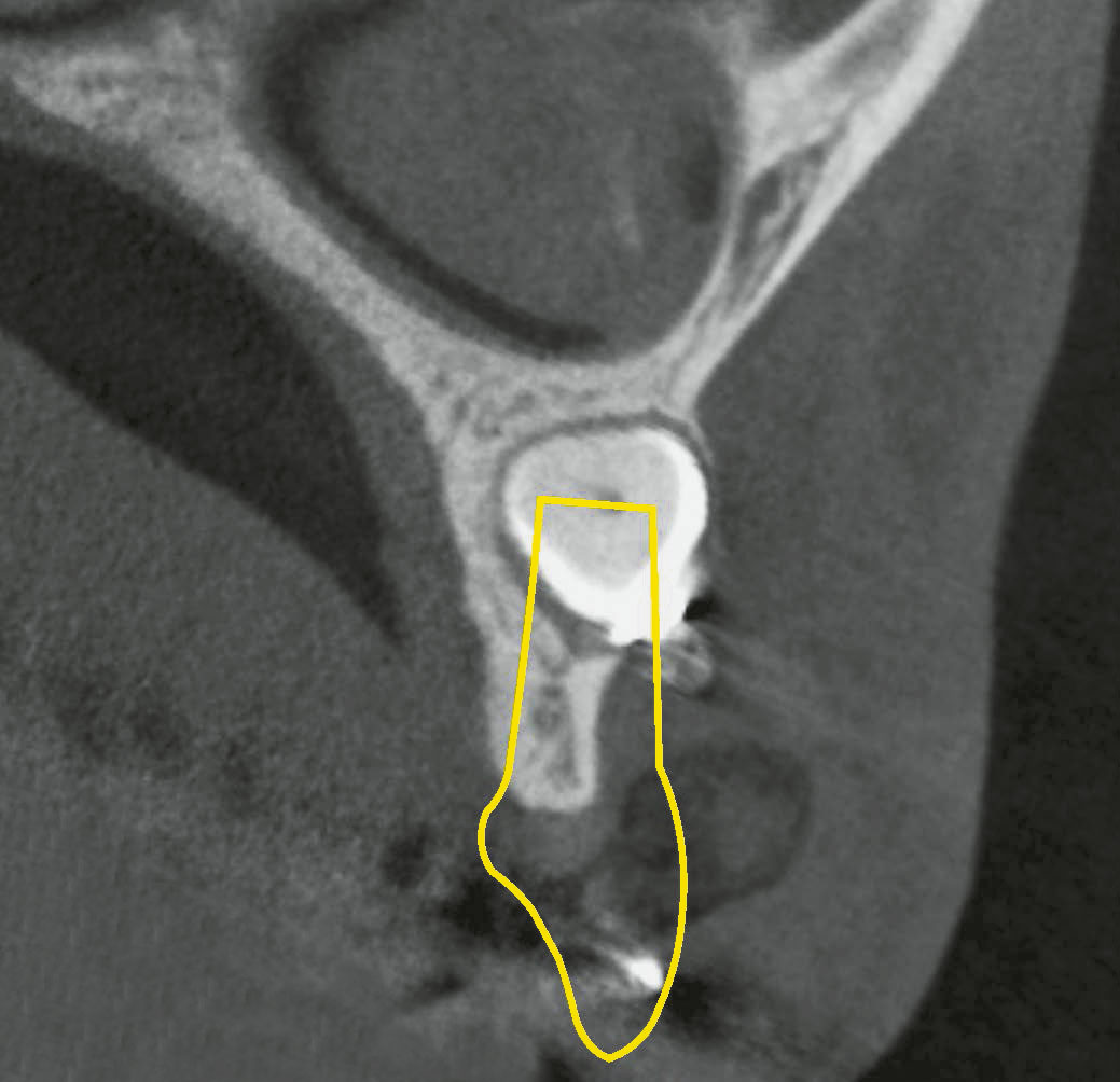 Abb. 21 ... und orofaziale Ansicht aus der DVT-­Aufnahme vor der intentionellen Replantation. Die Konturen des zu replantierenden Zahnes (gelb eingezeichnet) weisen auf die reduzierte Kammbreite hin.