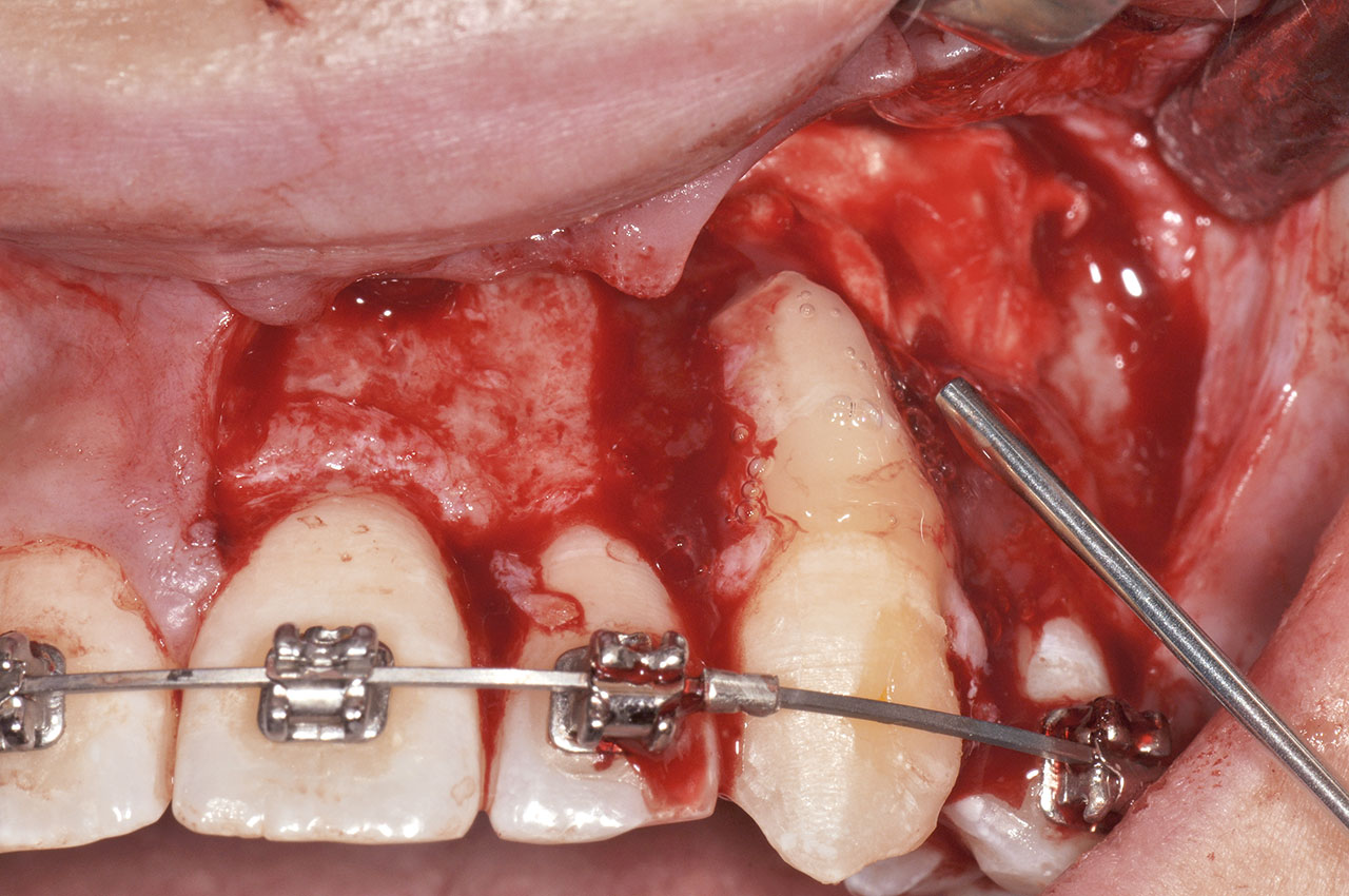 Abb. 25 Nach Wurzelkürzung und Anpassung der definitiven Zahnstellung in der Neoalveole erfolgte die topische Applikation von Schmelzmatrixproteinen.