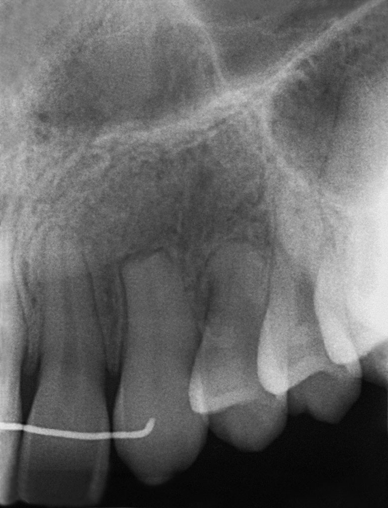 Abb. 33 ... und 20 Monate nach der Autotransplantation zeigen eine progressive Reossifikation des Knochendefektes um die ursprüngliche Alveole von Zahn 23 und die Wiederherstellung der Lamina dura um den Zahn. Deutliche Obliterationszeichen des Pulpakavums können nach 20 Monaten erkannt werden.
