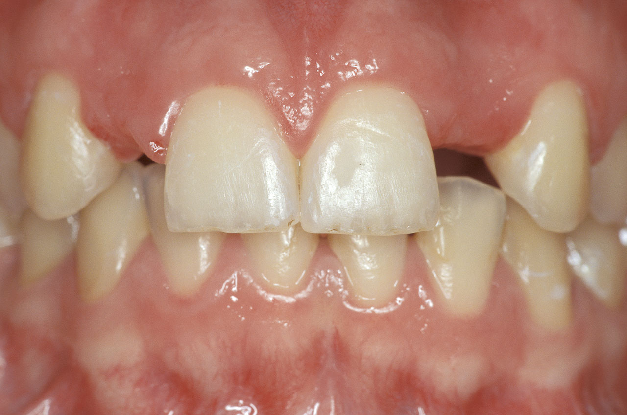 Abb. 1 20-jährige Patientin mit Nichtanlage der beiden oberen lateralen Schneidezähne nach Abschluss der kieferorthopädischen Vorbehandlung (Quelle: Kern<sup>6</sup>).