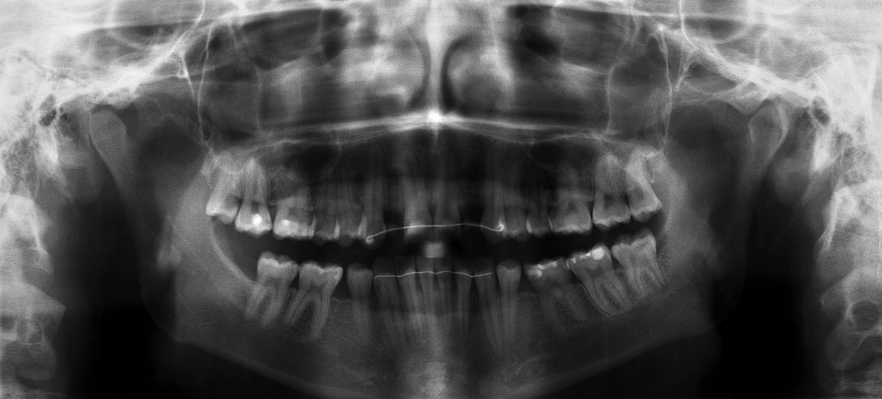 Abb. 2 Die Panoramaschichtaufnahme zeigt die nicht achsengerechte Stellung der die Lücken begrenzenden Zähne, welche insbesondere in Regio 12 die ursprünglich geplante Implantatversorgung sehr kritisch erscheinen lässt. Hier besteht ein hohes Risiko, dass die Nachbarzähne verletzt werden. Nach Aufklärung entschied sich die Patientin für die Eingliederung einflügeliger Adhäsivbrücken als minimalinvasive Therapiealternative (Quelle: Kern<sup>6</sup>).
