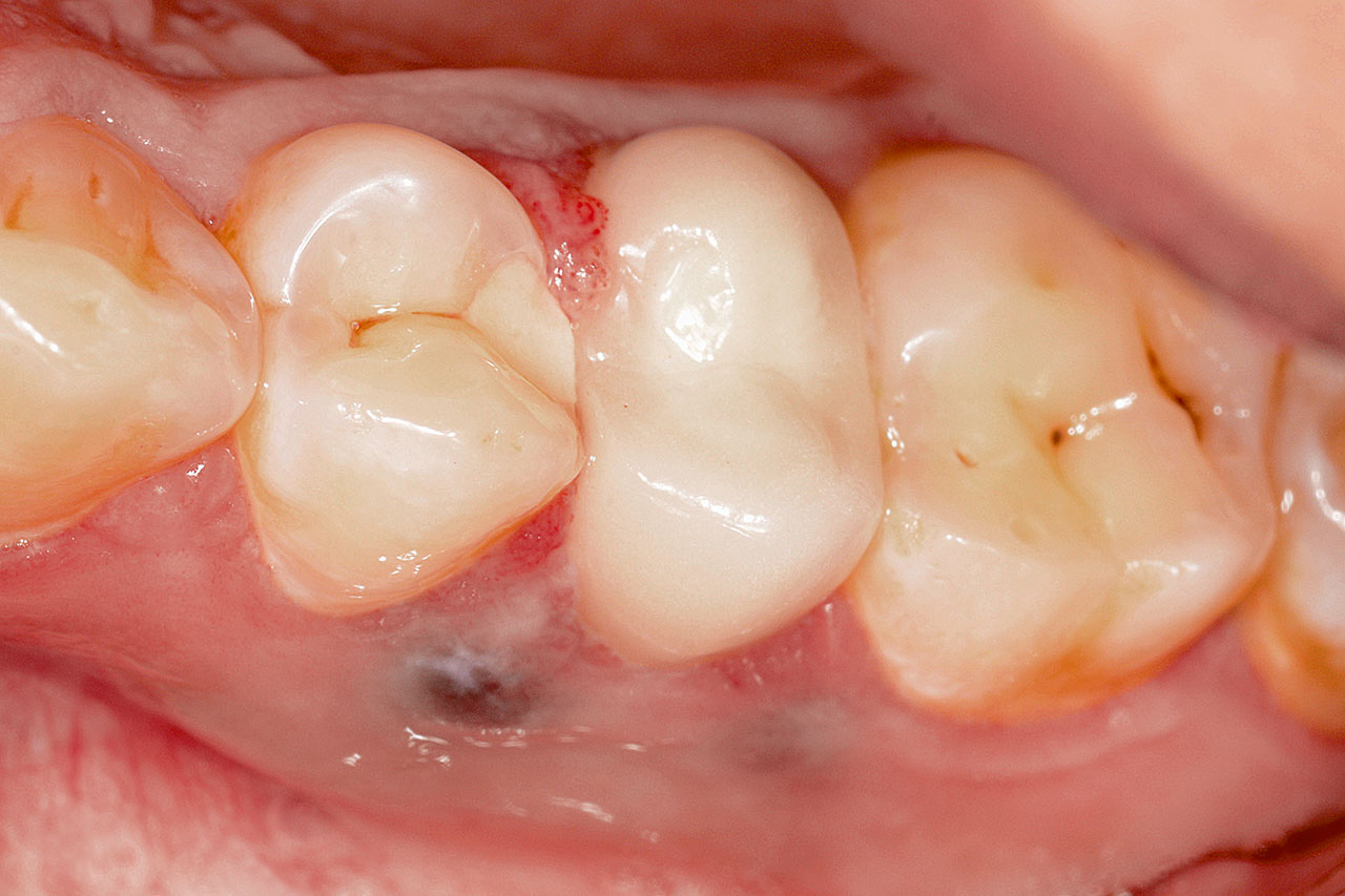 Abb. 1 Befund unmittelbar vor dem Eingriff: Zahn 15 mit metallkeramischer Restauration. Zahn 14 wurde kurz zuvor versorgt, so dass die Gingiva noch eine lokale Irritation zeigt. Materialbedingt verfärbte Schleimhautareale.